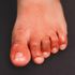 'COVID toes' may be side effect of body fighting virus, study finds thumbnail