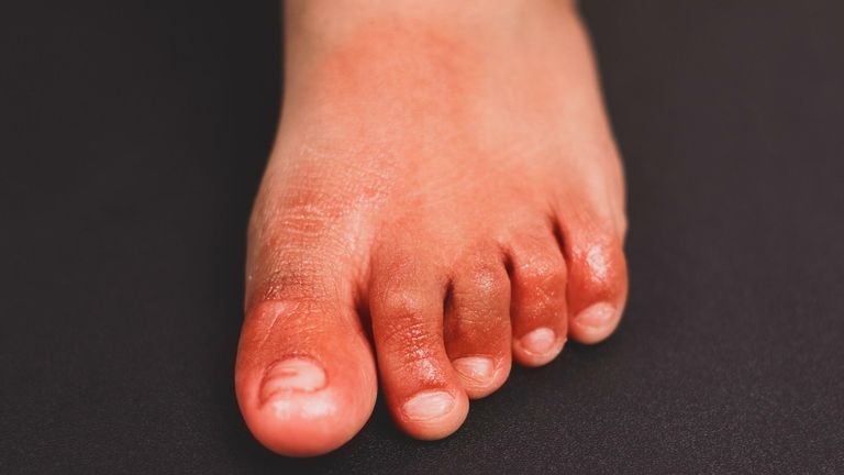 Painful red inflammation on toe called covid toe lesions strange sign of new coronavirus symptoms or infections

