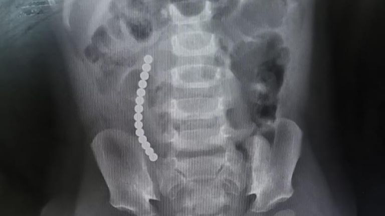 X-rays revealed the magnets were so strong they linked together inside her body and ruptured three parts of her intestine (Pic: RoSPA)
