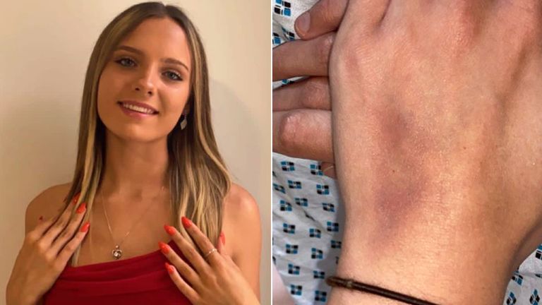 Sarah Buckle&#39;s hand showed a bruise, which she believes was caused by the needle