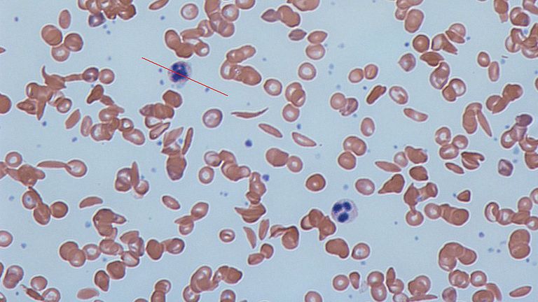 Sickle cells and normal red blood cells. Pic: Dr Graham Beards/CCv3