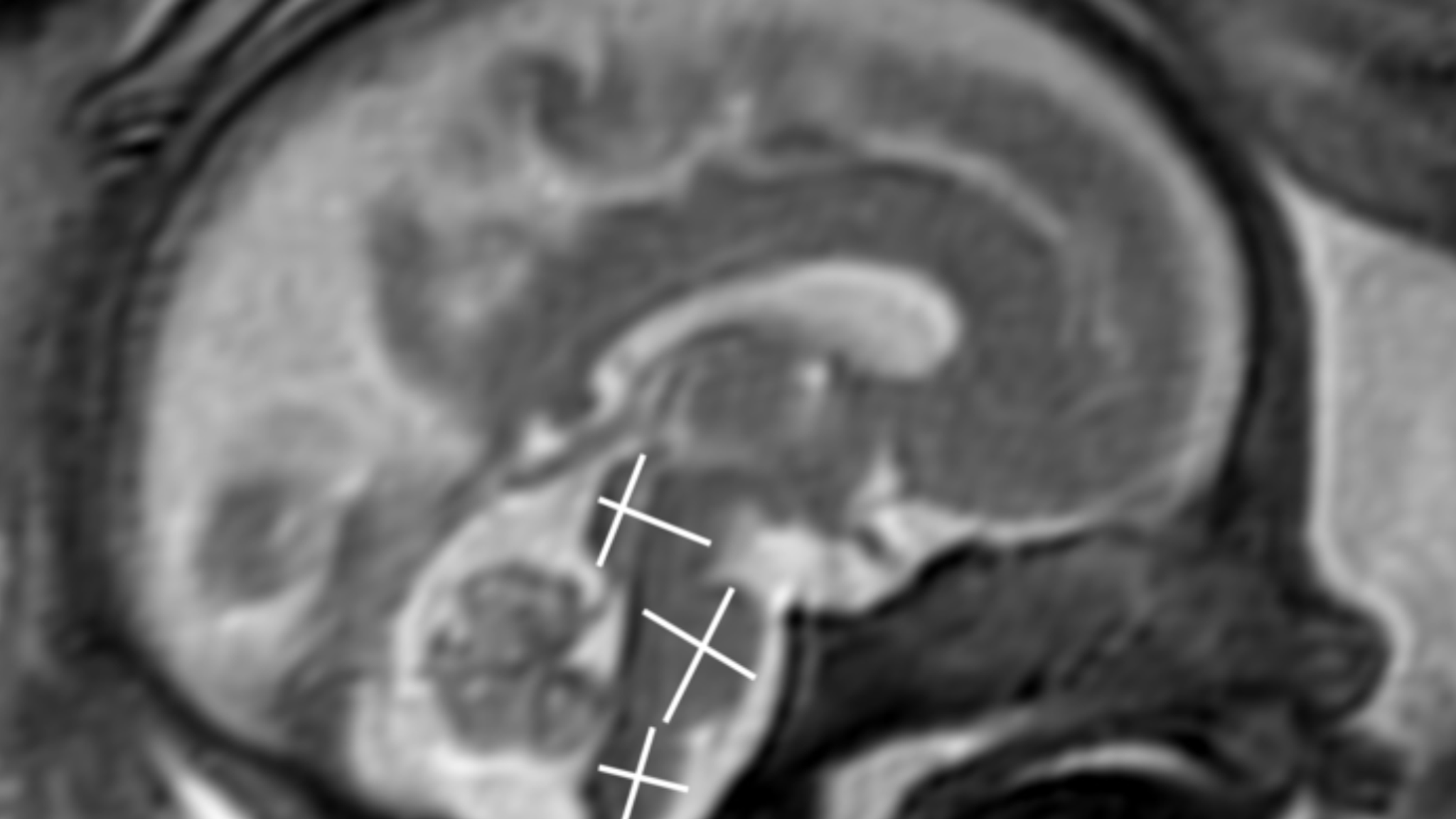 covid-19-mild-and-moderate-cases-during-pregnancy-doesn-t-harm-babies