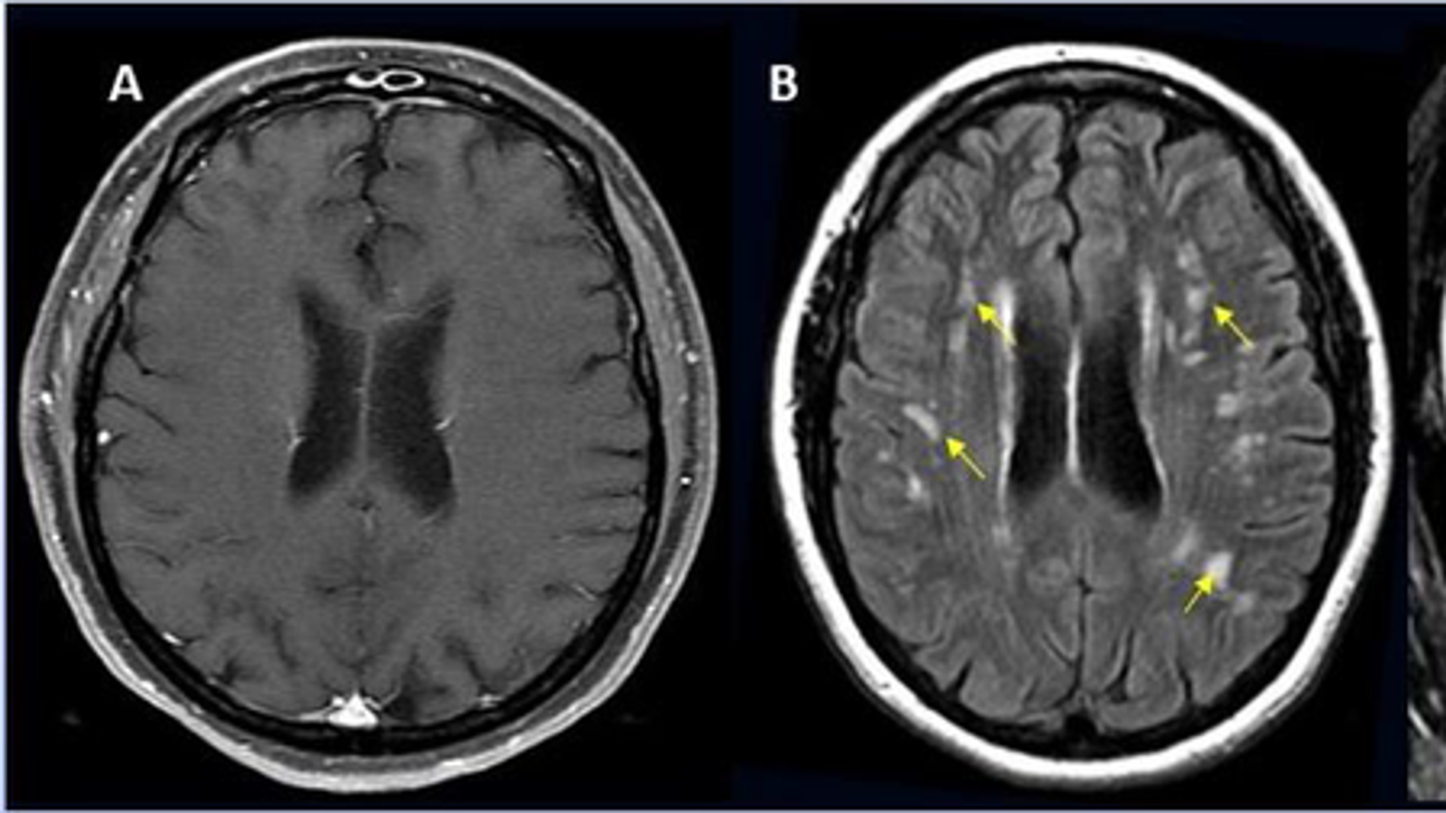 COVID19 New study calls for hospitalised patients to receive quicker