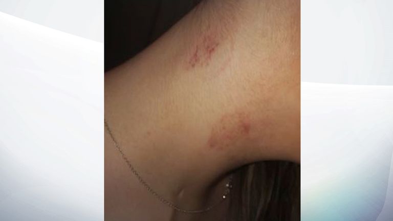 Anna suffered bruising to her neck