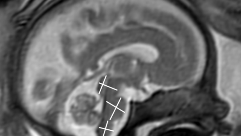 MRI of fetal brain development. Pic: RSNA/Stocklein