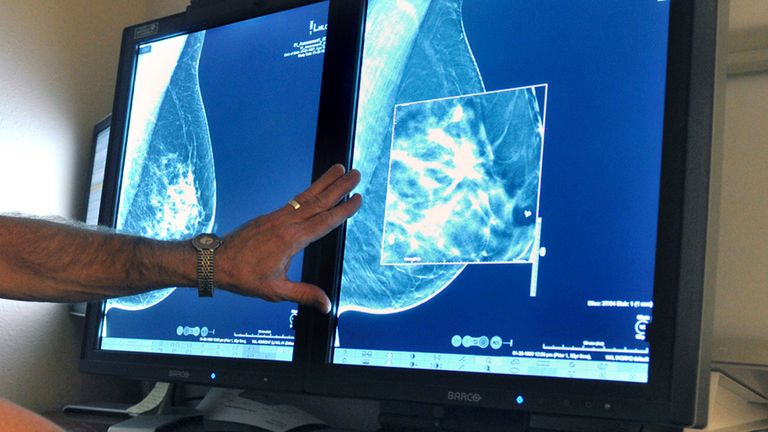 Around 1,000 women in the UK die each month from incurable secondary breast cancer Pic: AP