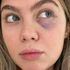 Love Island star shares image of bruised eye after being 'hit in the face for no reason' thumbnail