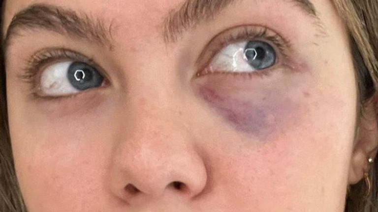 Belle Hassan shared images of her bruised eye on Instagram
