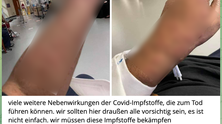 این عکس از عارضه جانبی ادعایی واکسن کرونا، یک روش متداول برای اطلاع‌رسانی نادرست، همراه با کتیبه‌ای به زبان آلمانی است که می‌گوید این نیش منجر به مرگ می‌شود و مردم باید با آن مبارزه کنند.