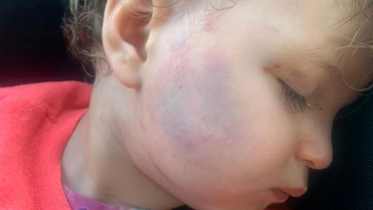 Star Hobson - West Yorkshire Police released image of bruises on the face of Star Hobson