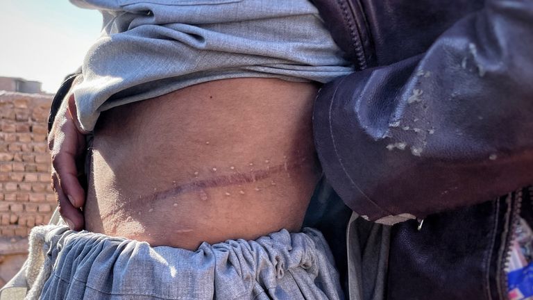 Men show us their kidney operation scars. Pic: Chris Cunningham