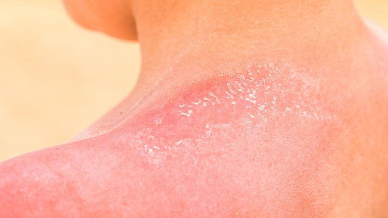 شانه کودکان از نزدیک با آفتاب سوختگی قرمز، که پوست را کنده می کند.  حفاظت از UV تابستان، مفهوم سلامت و تعطیلات ایمن