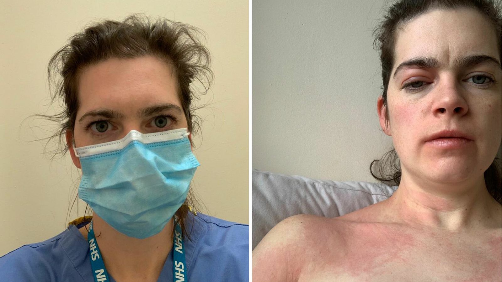 Изображение: д-р Кели Фърнли преди и след като се зарази