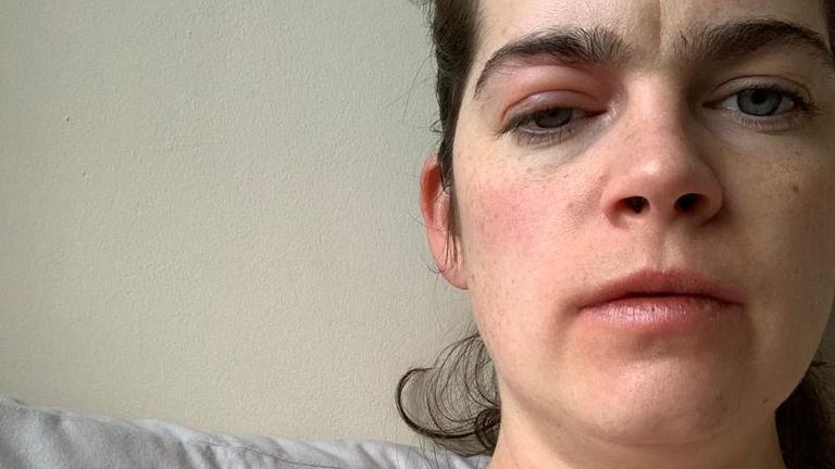 Dr Fearnley suffered swelling on her eyelid after contracting COVID