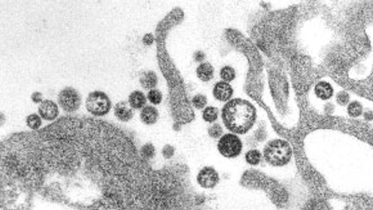 Lassa fever. Pic: CDC
