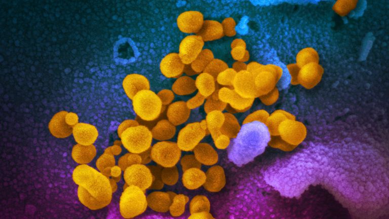 This undated electron microscope image made available by the U.S. National Institutes of Health in February 2020 shows the Novel Coronavirus SARS-CoV-2, yellow, emerging from the surface of cells, blue/pink, cultured in the lab. Also known as 2019-nCoV, the virus causes COVID-19. The sample was isolated from a patient in the U.S. (NIAID-RML via AP)
PIC:AP