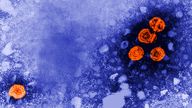 This 1981 electron microscope image made available by the U.S. Centers for Disease Control and Prevention shows hepatitis B virus particles, indicated in orange. The round virions, which measure 42nm in diameter, are known as Dane particles. On Wednesday, Nov. 3, 2021, a government advisory committee recommended that all U.S. adults younger than 60 be vaccinated against hepatitis B, because progress against the liver-damaging disease has stalled. (Dr. Erskine Palmer/CDC via AP)


