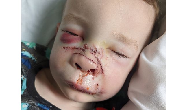 Dog attack: Mother's warning to parents after 'all of toddler son's nose ripped' from single bite - Vimarsana News