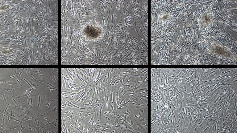 Researchers have reversed ageing in human skin cells by 30 years, according to a new study