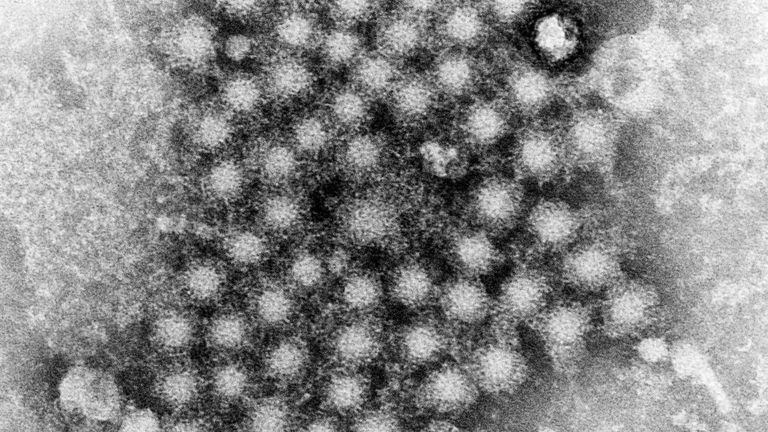 Numerous hepatitis virions of an unknown strain. File pic