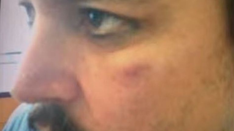 Johnny Depp says this picture shows him with an injury caused by Amber Heard