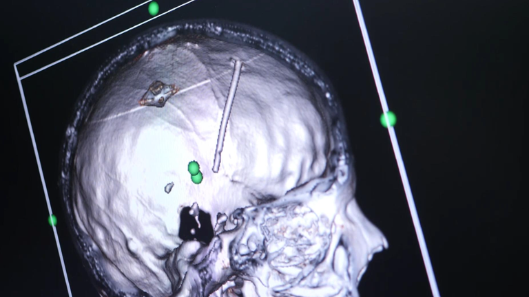 A brain scan shows where the shrapnel lodged in Sophia&#39;s brain