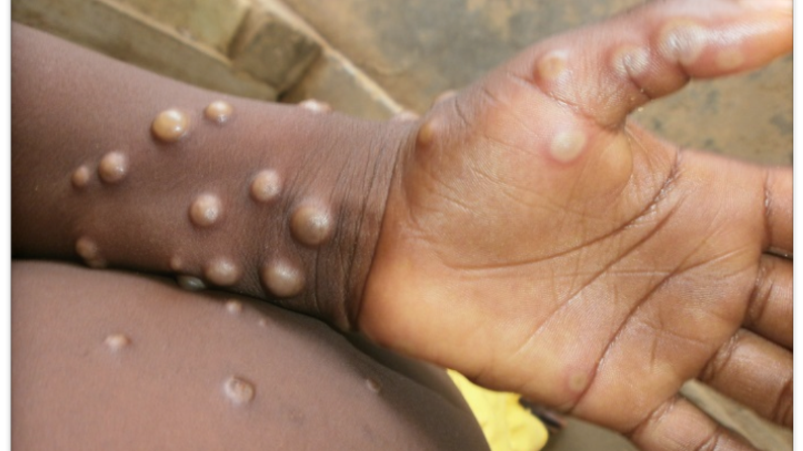 Rare case of monkeypox confirmed in England, UK Health Security Agency says  | UK News | Sky News