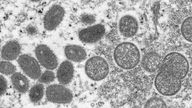 This electron microscopic (EM) image depicted a monkeypox virion, obtained from a clinical sample associated with the 2003 prairie dog outbreak. It was a thin section image from of a human skin sample. On the left were mature, oval-shaped virus particles, and on the right were the crescents, and spherical particles of immature virions..High Resolution:.Click here for hi-resolution image (5.21 MB).Content Providers(s):.CDC/ Cynthia S. Goldsmith.Creation Date:.2003.Photo Credit:.Cynthia S. Goldsmith, Russell Regnery
