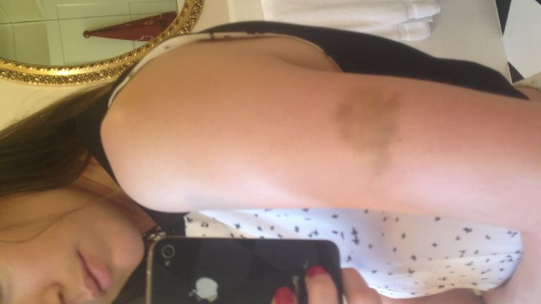 This photo of Amber Heard with a bruise on her arm was shown to the court