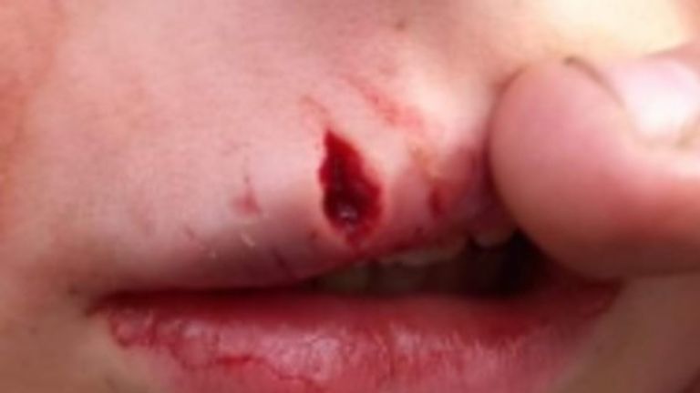 Police appeal for more information after a 9-year-old boy was bitten on the face by a dog in Stroke-on-Trent.