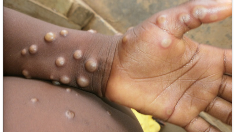 Pic: WHO/Nigeria Centre for Disease Control