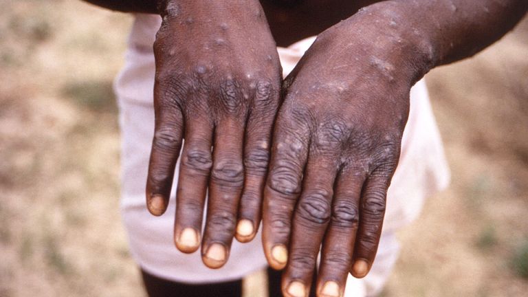 A monkeypox patient in the Democratic Republic of the Congo. Pic: CDC
