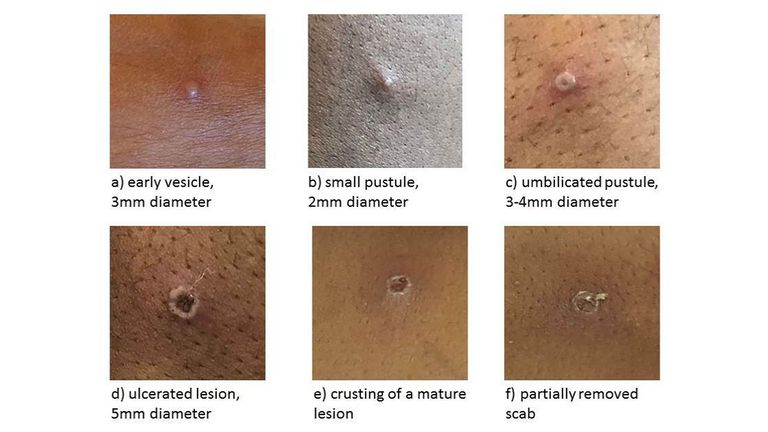 Undatiertes Handout-Bild, herausgegeben von der UK Health Security Agency der Monkeypox-Stadien.  Zwei weitere Fälle von Affenpocken wurden in England bestätigt, sagten Gesundheitsbosse.  Eine der beiden Personen, die im selben Haushalt leben, wird im Krankenhaus behandelt, teilte die britische Gesundheitsbehörde mit.  Ausgabedatum: Samstag, 14. Mai 2022.