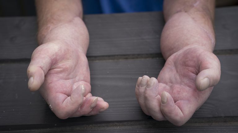 EMBARGOED TO 0001 THURSDAY MAY 26 Steven Gallagher, from Dreghorn, Ayrshire, is the first person in the world to have a double hand transplant after suffering from the rare disease scleroderma. Picture date: Tuesday May 24, 2022.
