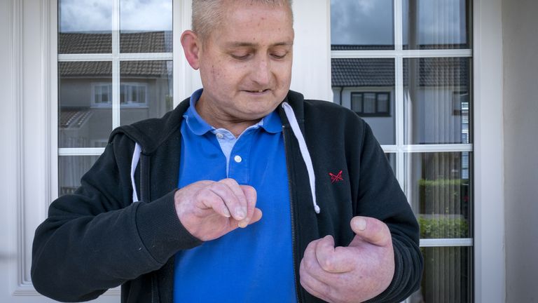 EMBARGOED TO 0001 THURSDAY MAY 26 Steven Gallagher, from Dreghorn, Ayrshire, is the first person in the world to have a double hand transplant after suffering from the rare disease scleroderma. Picture date: Tuesday May 24, 2022.
