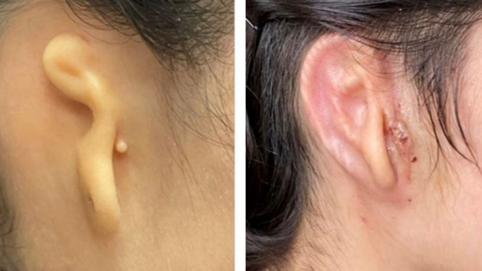 Una mujer obtiene su primera oreja nueva impresa en 3D a partir de sus propias células en un trasplante ‘revolucionario’ |  noticias de ciencia y tecnologia