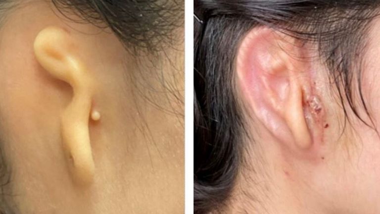 Pic: Microtia-Congenital Ear Institute and 3DBio Therapeutics.