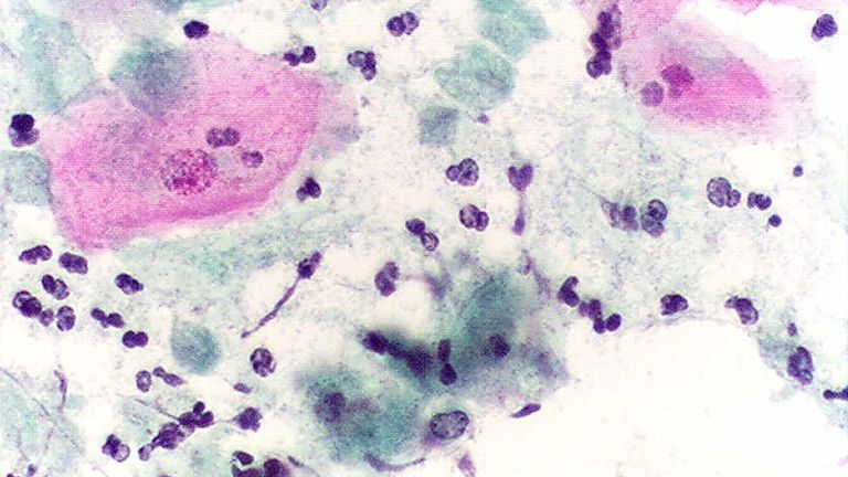 A pap smear, showing infection by Trichomonas vaginalis