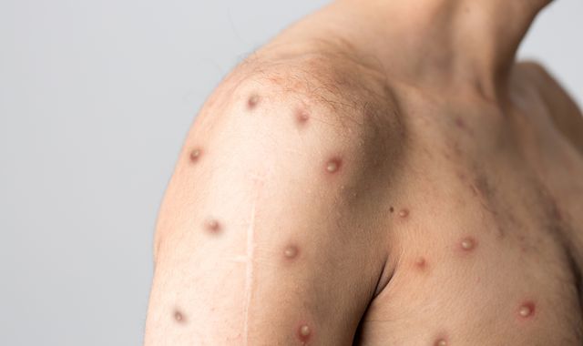 Monkeypox declared global health emergency by World Health Organisation, as risk in Europe described as