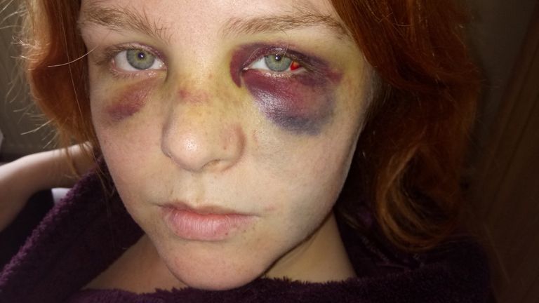 Beth McDonald, also known as Beth Blade, is speaking out after being attacked by her former partner