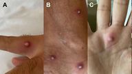 Large spots on the body of a man who was found to be suffering from monkeypox. Pic: Journal of Infection
