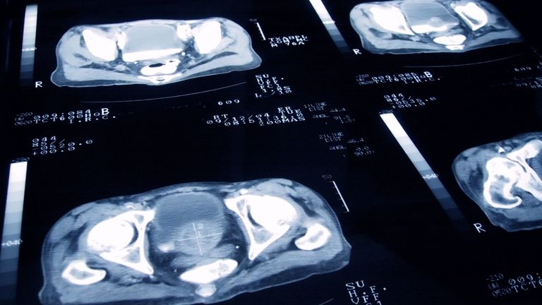 Using the VERDICT MRI scan alongside standard imaging techniques was found to be significantly better at identifying men who do not have prostate cancer (file image). Pic: iStock