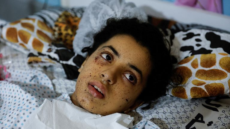 Gadis Palestina yang terluka Rahaf Salman, 11, yang kehilangan anggota tubuhnya selama pertempuran Israel-Gaza, berbaring di ranjang rumah sakit, saat gencatan senjata berlangsung, di Jalur Gaza utara, 9 Agustus 2022. REUTERS/Mohammed Salem