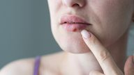 The herpes simplex virus can cause oral and genital sores 