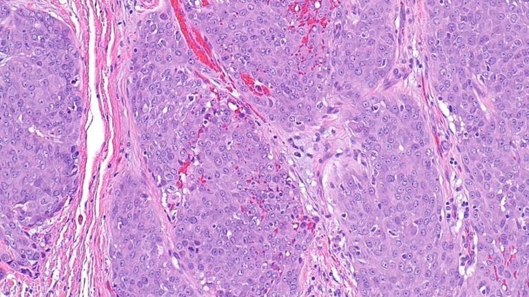 Image : Carcinome des glandes salivaires.  Crédit : Nephron, CC BY-SA 4.0, via Wikimedia Commons