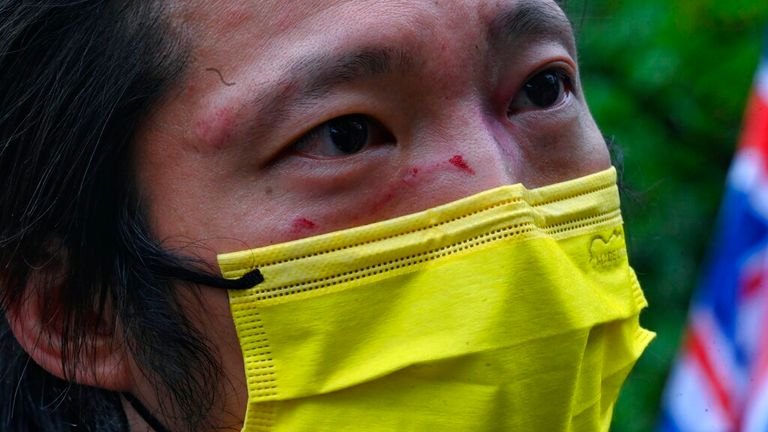 Protester Bob Chan says he was left him with cuts and bruises all over his body. Pic: AP