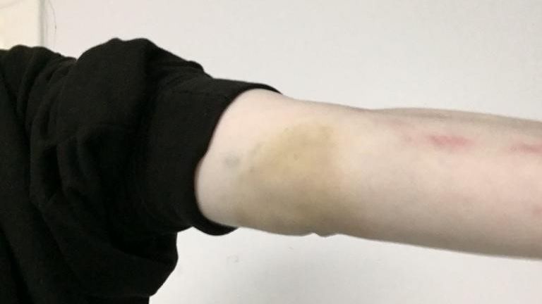 Another patient named Danae reveals bruise from over restraint