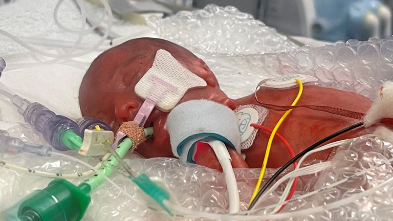 Born weighing 1lb at 23 weeks: The very real costs of having a