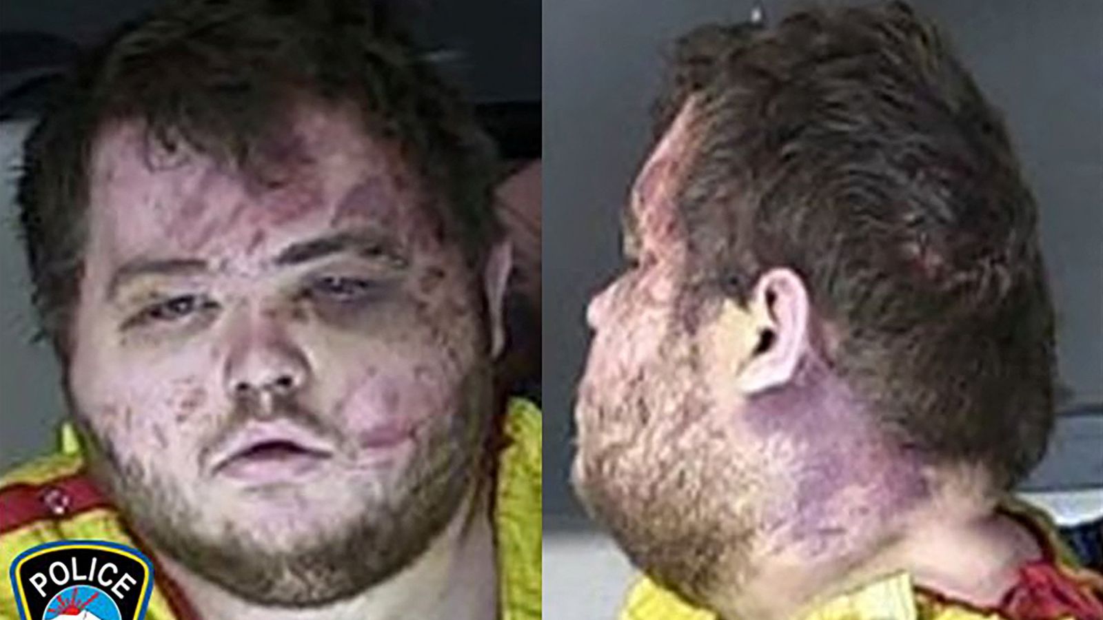 Mugshot of Colorado gay club shooting suspect shows injuries sustained during confrontation with 'heroic people'