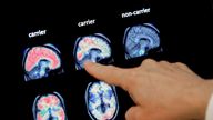 ** HOLD FOR RELEASE/PUBLICATION DATE TBD FOR MEDICAL WRITER MARILYNN MARCHIONE STORY ** Dr. William Burke goes over PET brain scan Tuesday, Aug. 14, 2018 at Banner Alzheimers Institute in Phoenix. It may be too late to stop Alzheimer&#39;s in people who already have some mental decline but Banner is conducting two studies that target the very earliest brain changes while memory and thinking skills are still intact in hope of preventing the disease. (AP Photo/Matt York).
